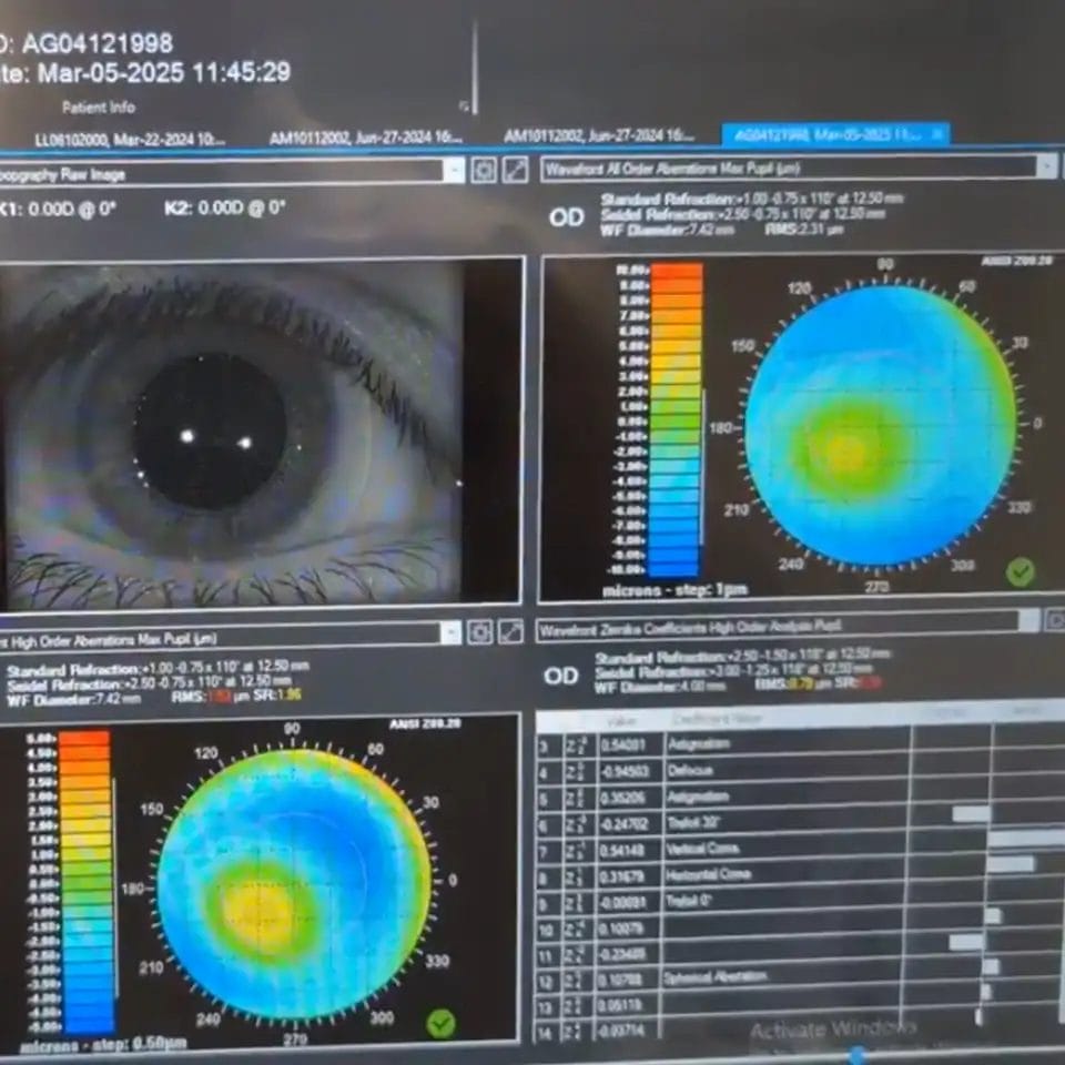 Những lợi ích chính của kính scleral trong việc kiểm soát loạn thị cao